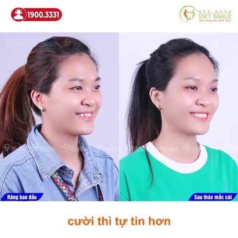 THÁO NIỀNG RĂNG CHEN CHÚC, MỌC VẾCH CHỈ SAU 1 NĂM